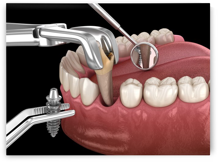 Extraction and Implantation complex immediate surgery by Alex Mit