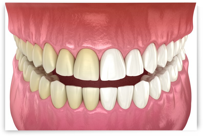 Teeth whitening - before and after. Dental concept by Alex Mit