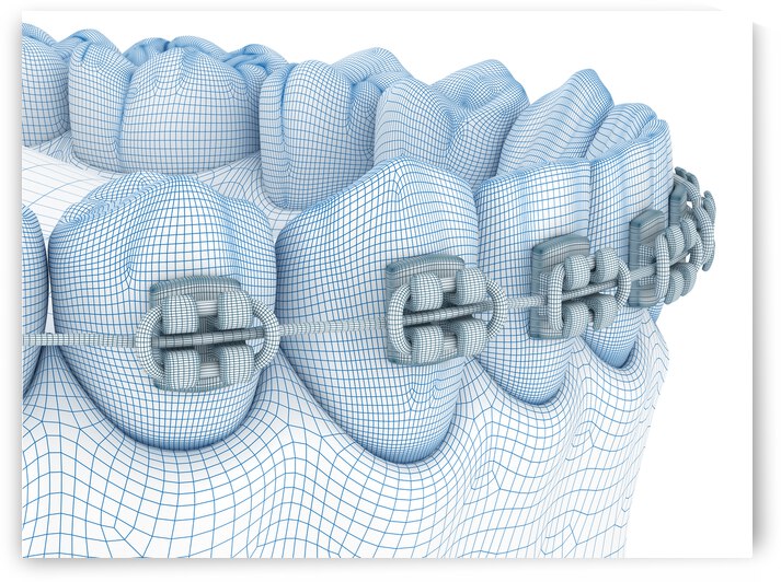 Braces and denture. Wire 3d model illustration by Alex Mit