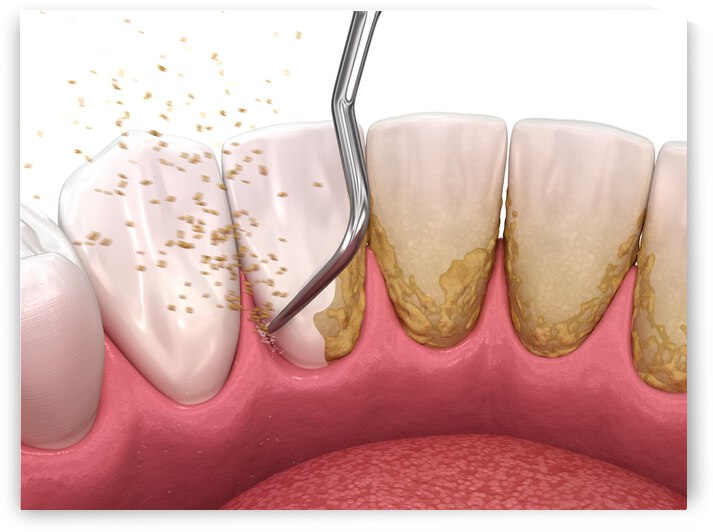 Oral hygiene: Scaling and root planing conventional periodontal therapy by Alex Mit