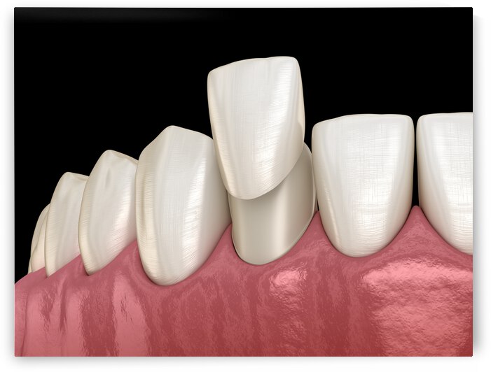 Veneer placement procedure 3D illustration by Alex Mit
