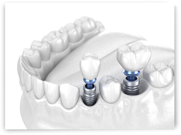 Premolar and Molar tooth crown installation over implant - white concept by Alex Mit