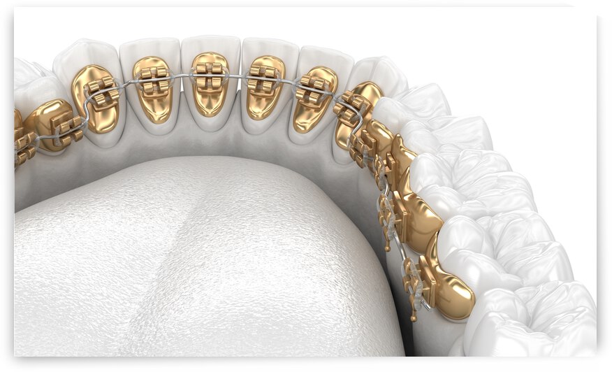 Healthy Teeth with gold braces white style concept dental 3D illustration by Alex Mit