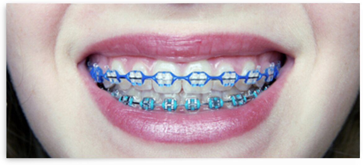 Braces by Dr Richard Halpern Orthodontist Calgary