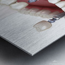 Dental bridge and crown placement over implants Metal print