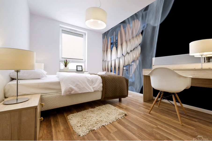 Teeth recovery with implants x-ray view. Mural print