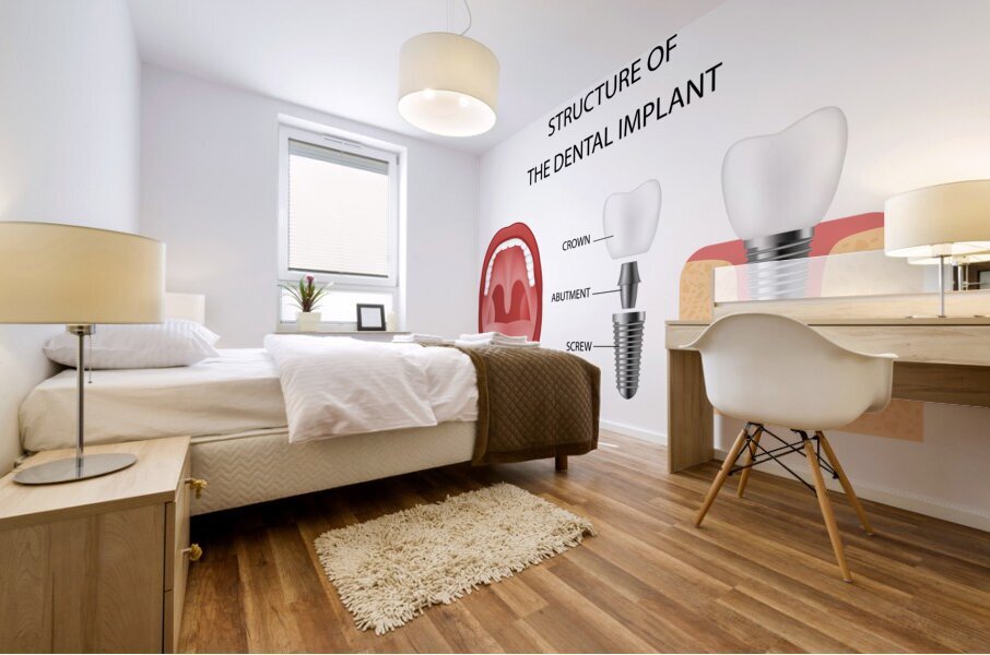 Dental implant structure Mural print