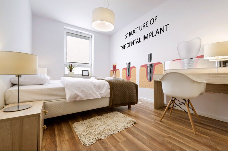 Structure of the dental implant Mural print