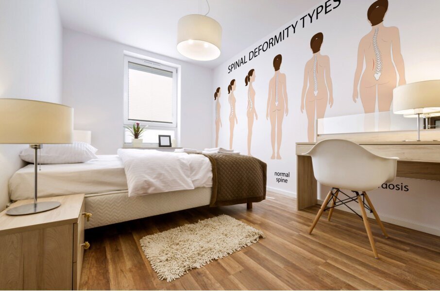 Spinal deformity types Mural print