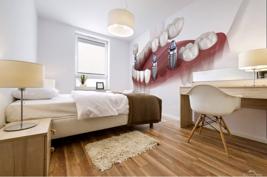 Dental bridge and crown placement over implants Mural print