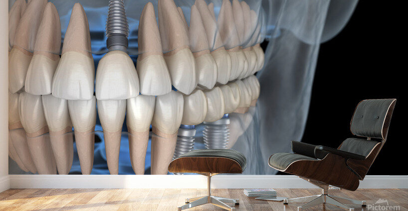 Teeth recovery with implants x-ray view. Wall Murals