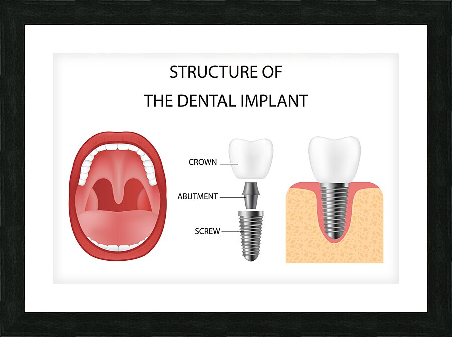 Dental implant structure Picture Frame print