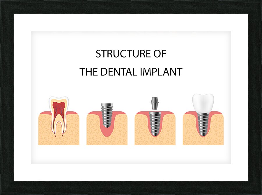 Structure of the dental implant Picture Frame print