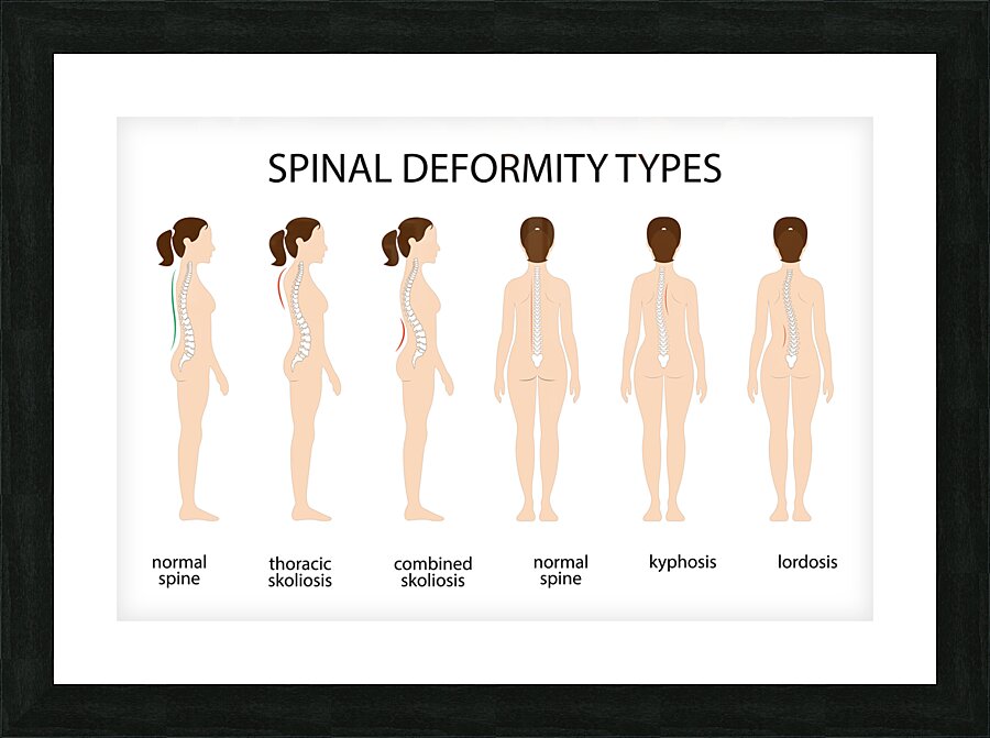 Spinal deformity types Picture Frame print