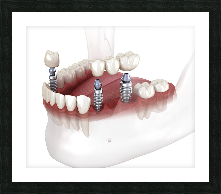 Dental bridge and crown placement over implants Picture Frame print