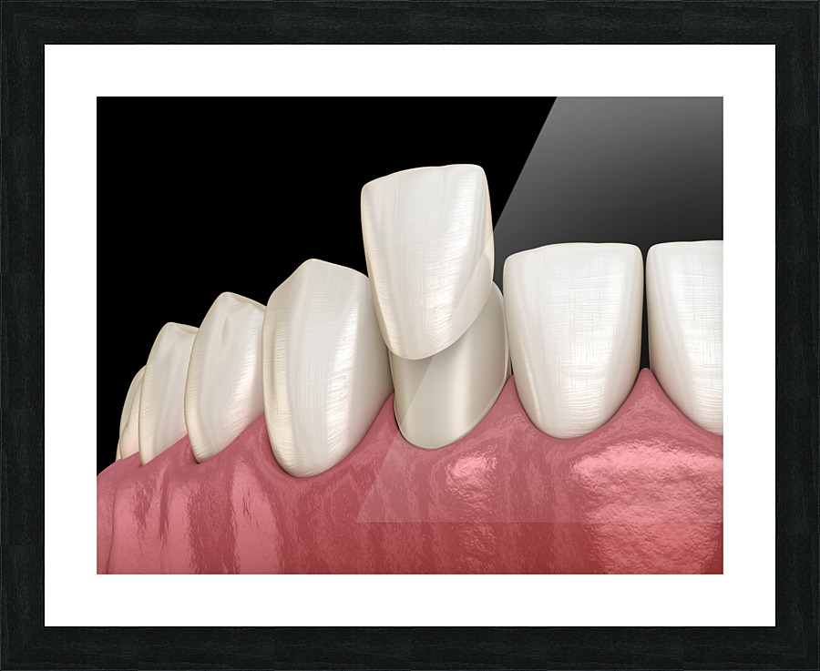 Veneer placement procedure 3D illustration Picture Frame print
