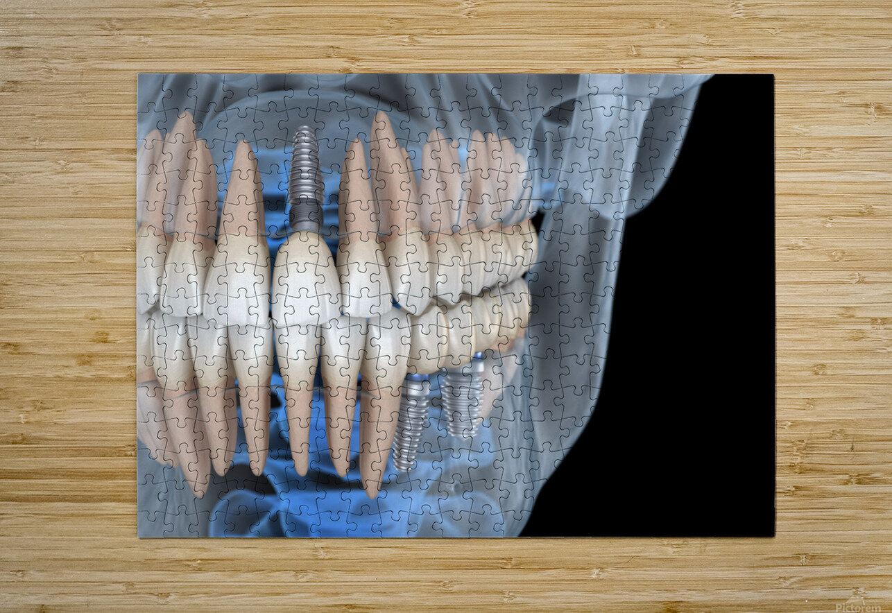 Teeth recovery with implants x-ray view. Alex Mit Puzzle printing