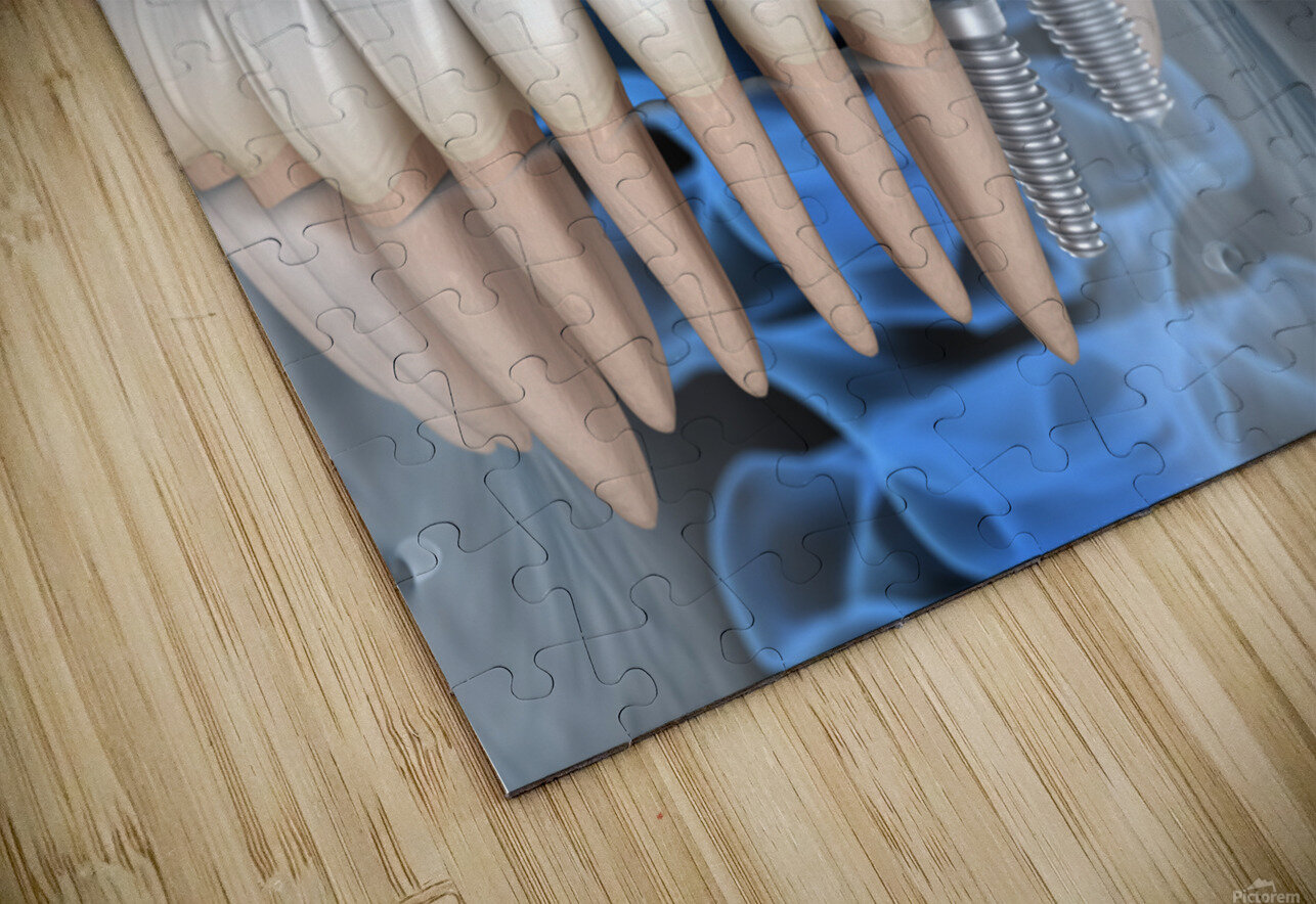 Teeth recovery with implants x-ray view. Alex Mit Puzzle