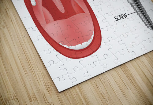 Dental implant structure Point Art puzzle