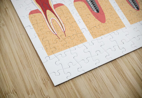 Structure of the dental implant Point Art puzzle