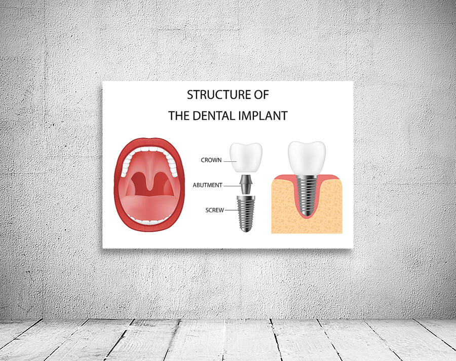 Dental implant structure Wall Preview