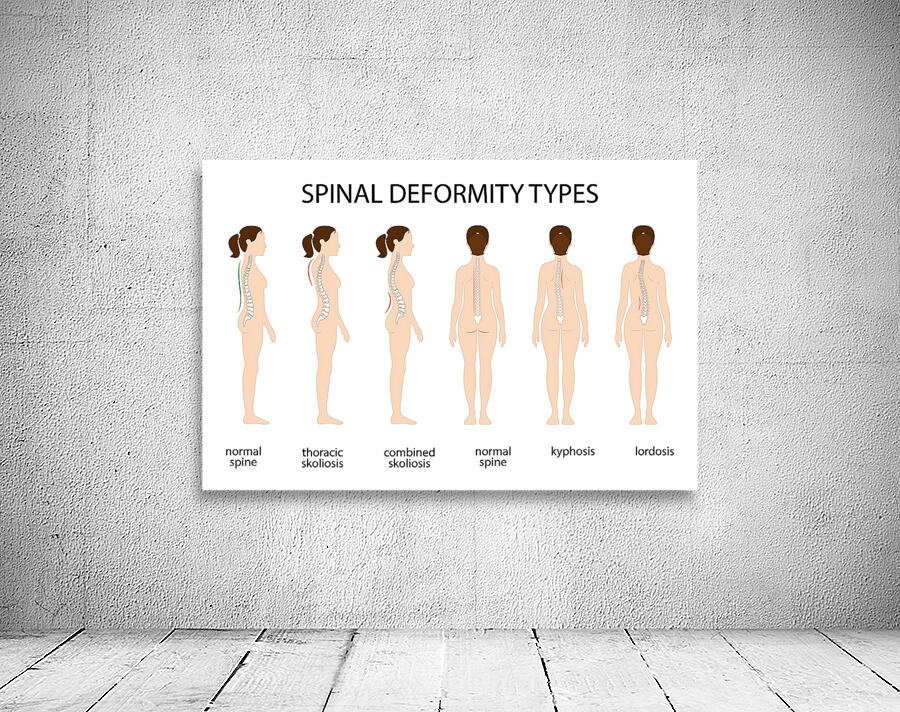 Spinal deformity types Wall Preview