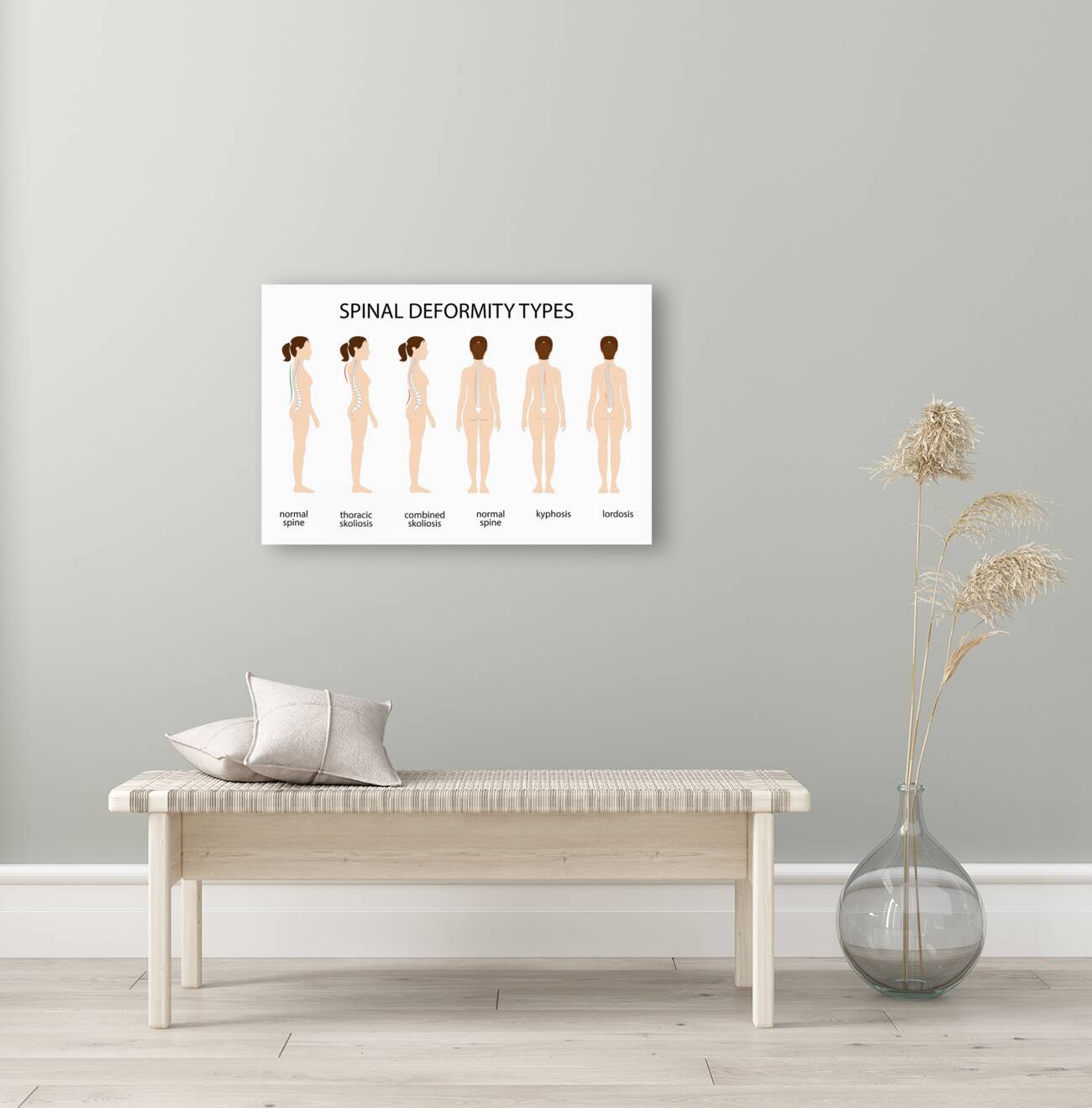 Spinal deformity types Reproduction