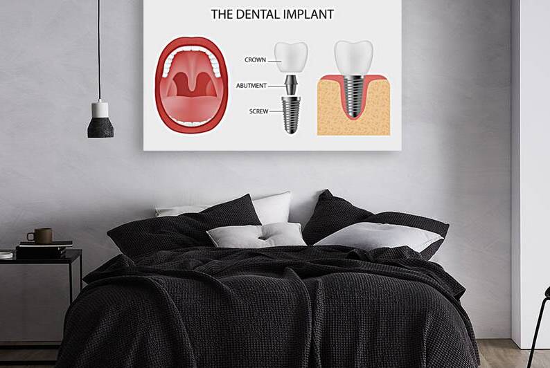 Dental implant structure by Point Art
