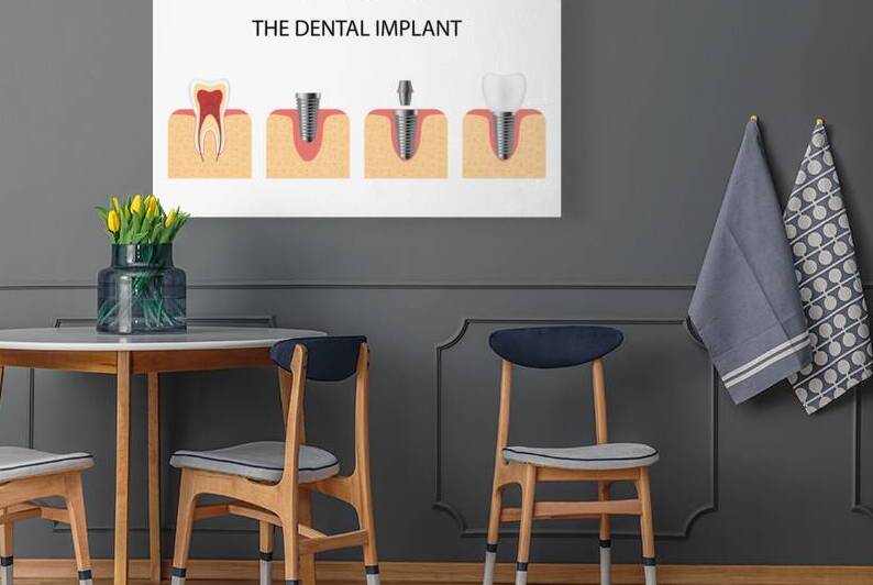 Structure of the dental implant by Point Art