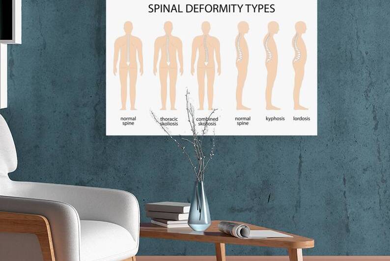 Anatomy of Spine deformity by Point Art