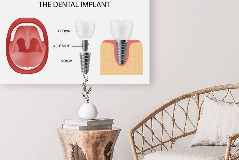 Dental implant structure by Towseef Dar
