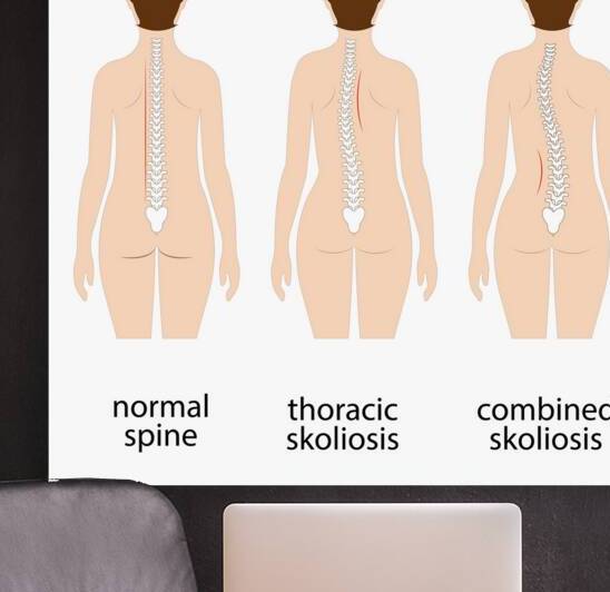 Spinal deformity by Towseef Dar