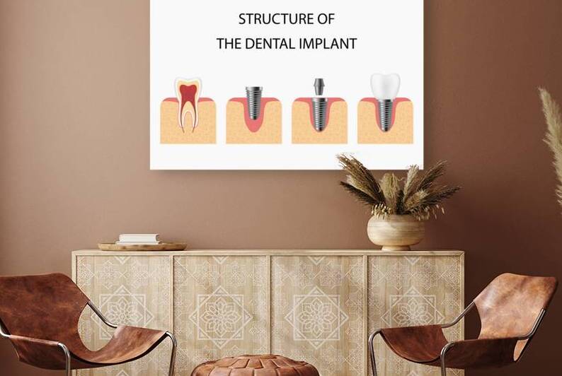 Structure of the dental implant by Towseef Dar