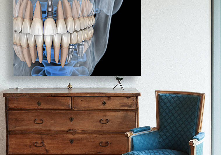 Teeth recovery with implants x-ray view. by Alex Mit