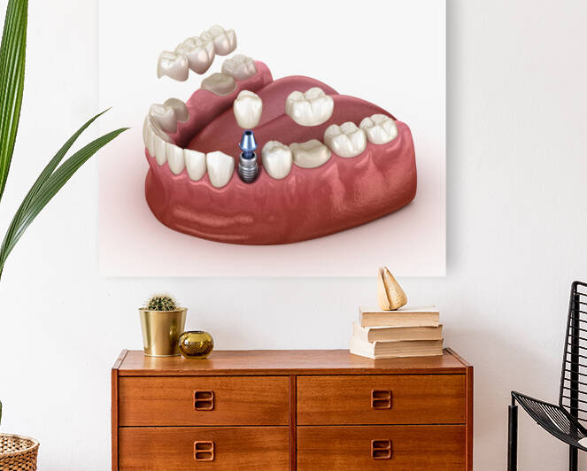 Tooth recovery with implant and crown 3d illustration by Alex Mit