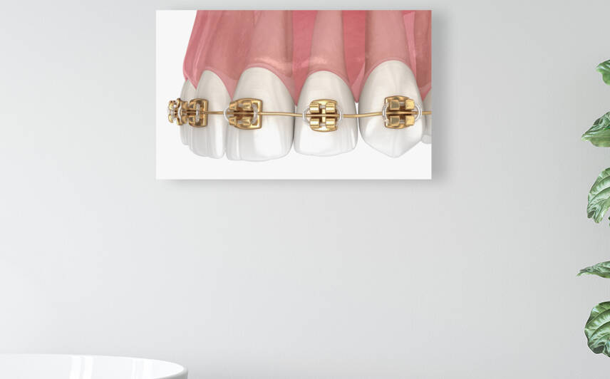 Golden braces tretament macro view by Alex Mit