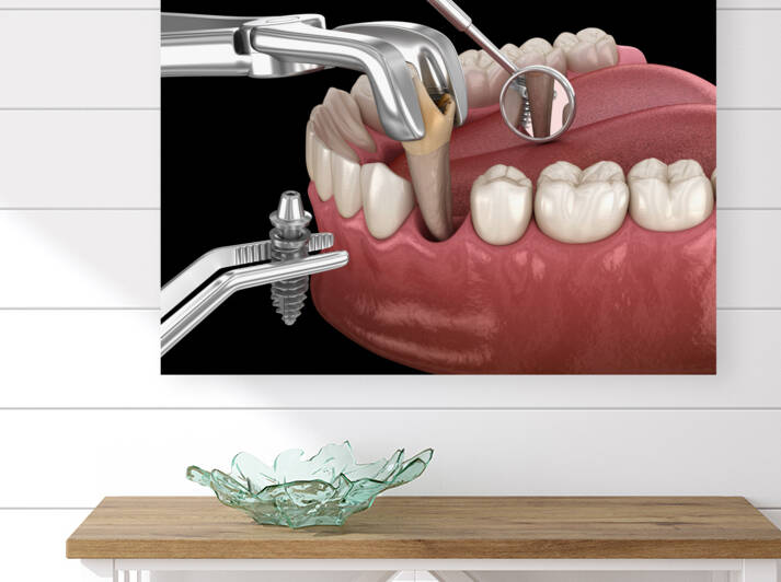 Extraction and Implantation complex immediate surgery by Alex Mit