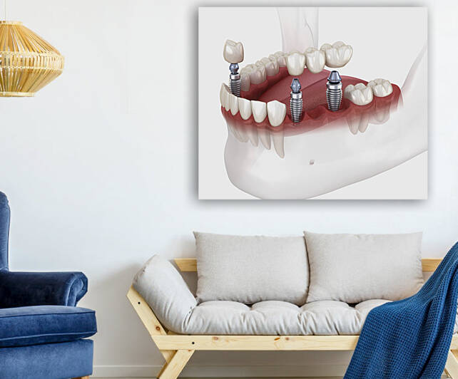 Dental bridge and crown placement over implants by Alex Mit