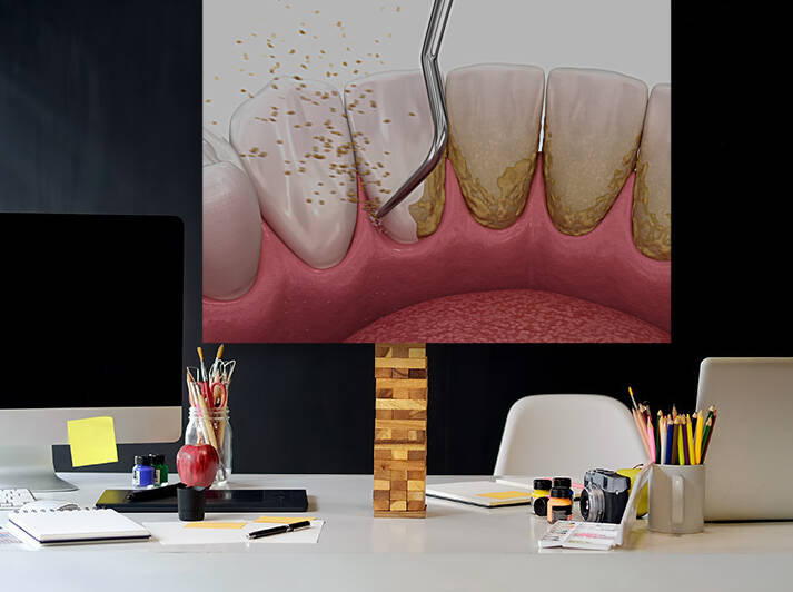 Oral hygiene: Scaling and root planing conventional periodontal therapy by Alex Mit