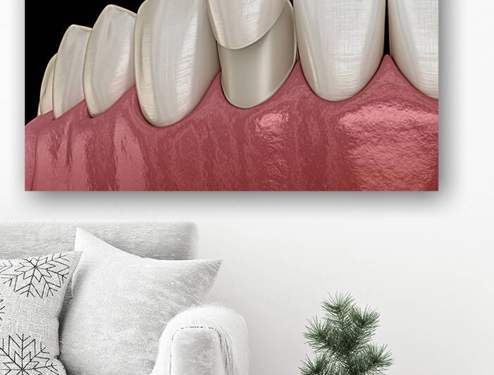 Veneer placement procedure 3D illustration by Alex Mit