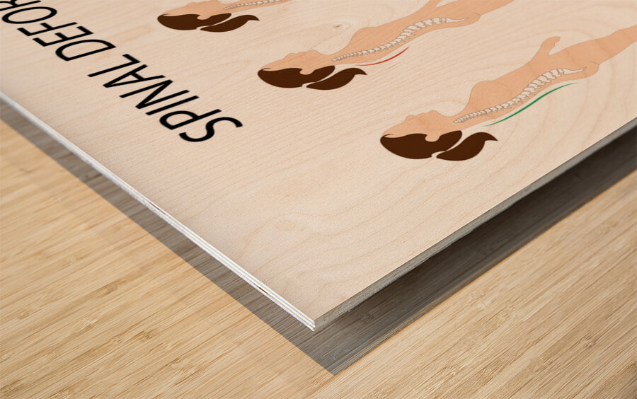 Spinal deformity types Wood print